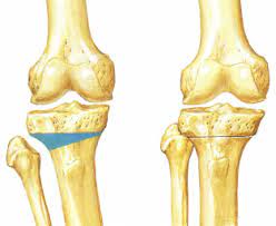 Diz Osteotomisi Nedir?