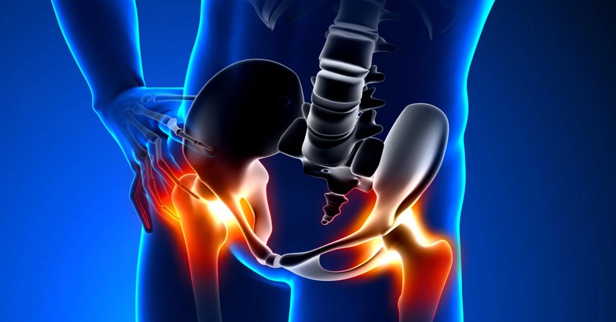 Kalça Kireçlenmesi Belirtileri Kalça Kireçlenmesi Belirtileri