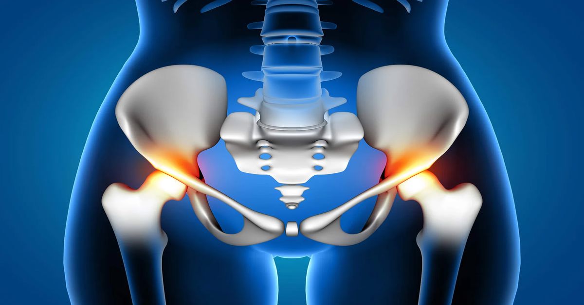 Kalça Kireçlenmesi Belirtileri Kalça Kireçlenmesi Belirtileri