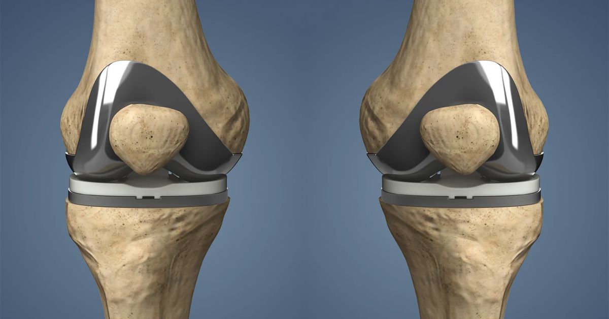 Kapalı Diz Ameliyatı Kapalı Diz Ameliyatı