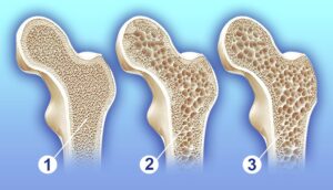 Kemik Erimesi (Osteoporoz) Neden Olur?