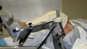 Robotik Diz Protezi Cerrahisi