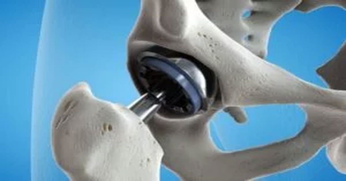 Kalçada Protez Ameliyatı Kalçada Protez Ameliyatı