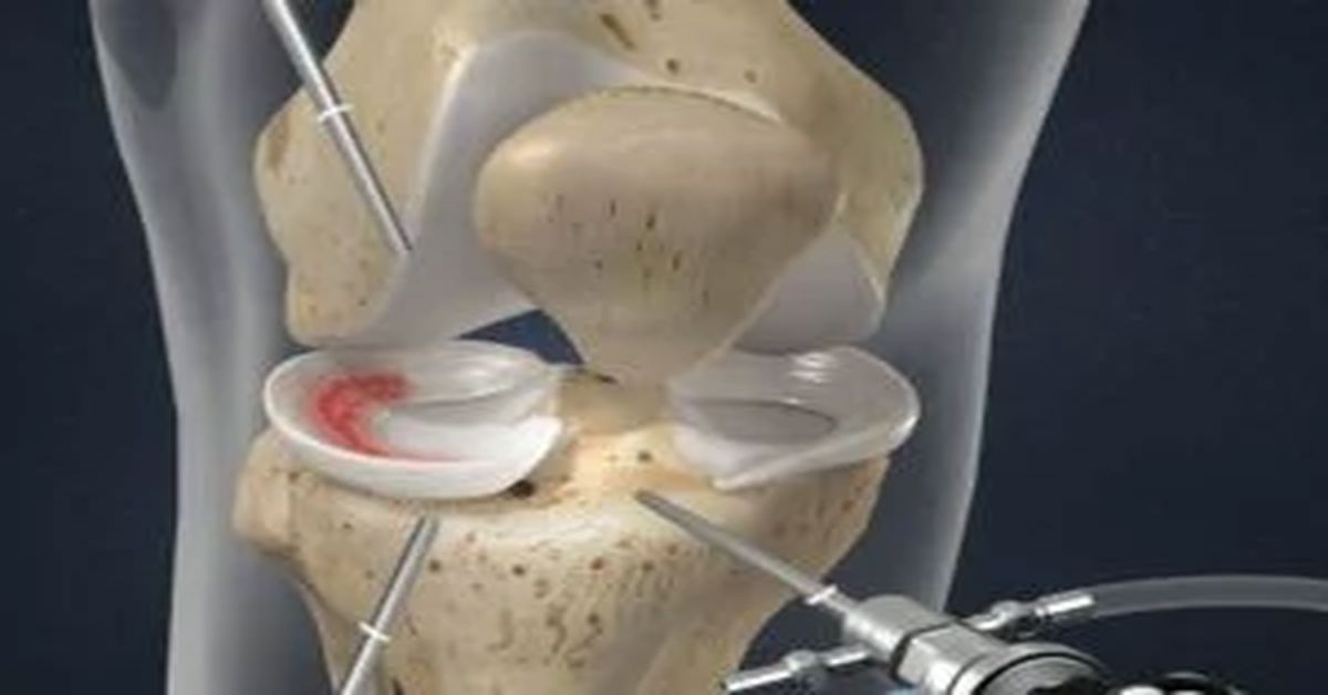 Gençlerde Menisküs Yırtığı Gençlerde Menisküs Yırtığı