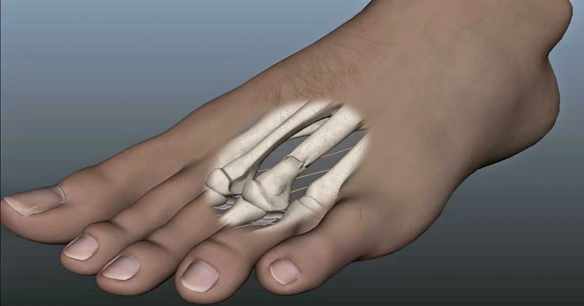 Stres Kırığı Stres Kırığı