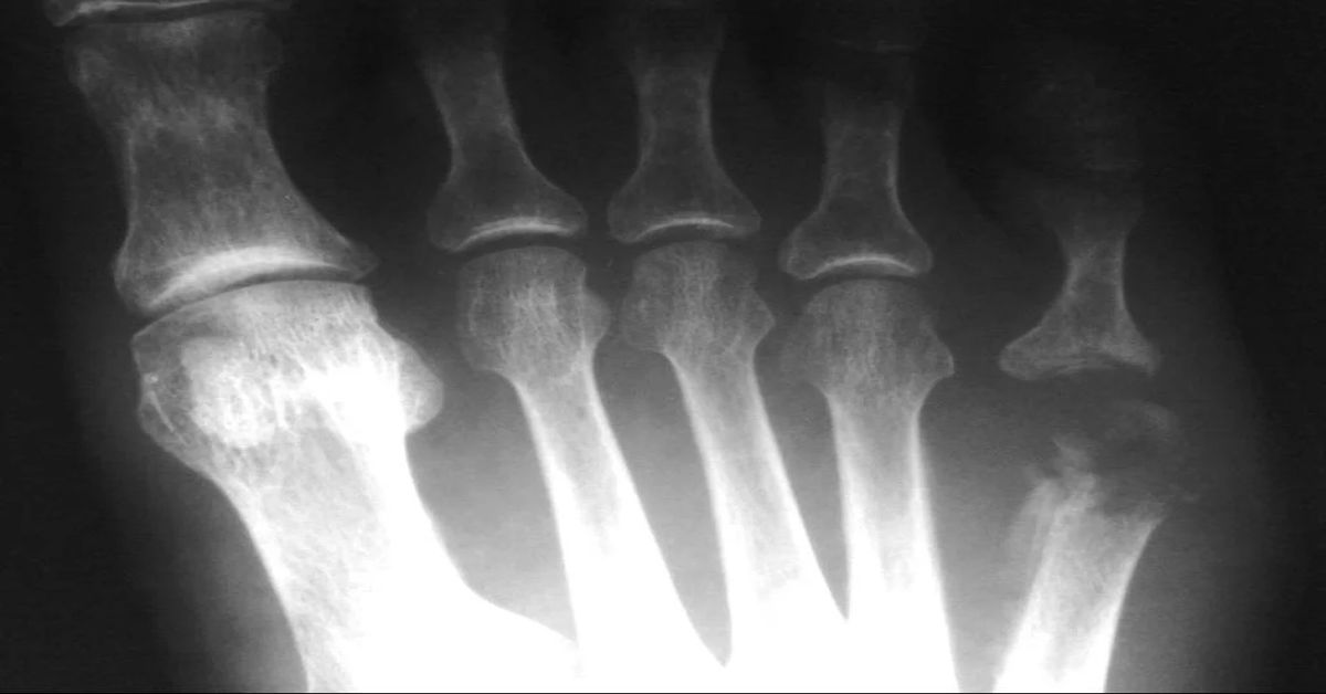 Kemik Enfeksiyonu Kemik Enfeksiyonu