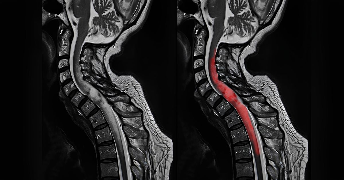 Omurga Tümörü Tedavisi
