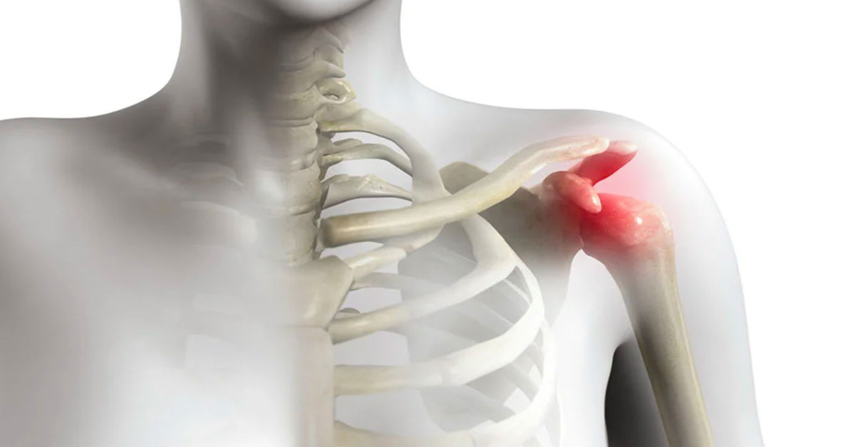 Omuz Sıkışması Ameliyatı