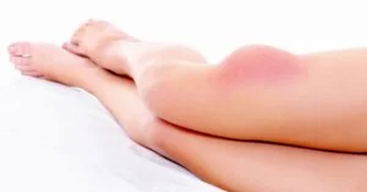 Yumuşak Doku Tümörü Tedavisi