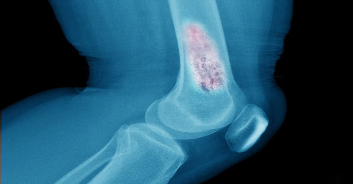 Yumuşak Doku Tümörü Nedir? Yumuşak Doku Tümörü Nedir?